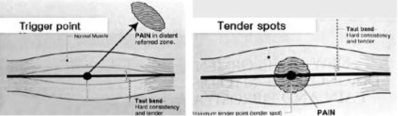 Fig. 1. The difference between the trigger points(TrPs) and tender spots(TSs)