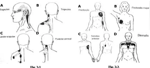 Fig. 2. Myofascial pain patterns showing the trigger point(X) and its pain referral pattern(solid black and stippling)