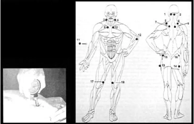 Fig. 3. Tender points of the fibromyalgia