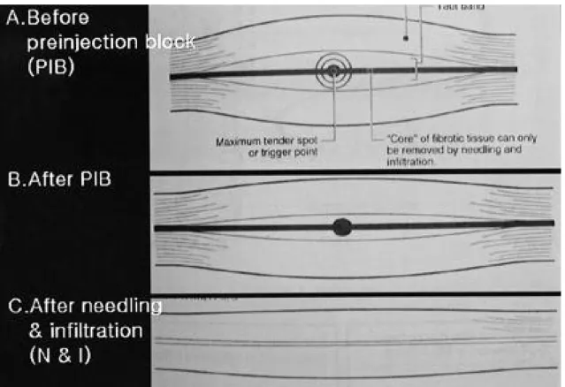 Fig. 4. Effect of preinjection block and needling and infiltration