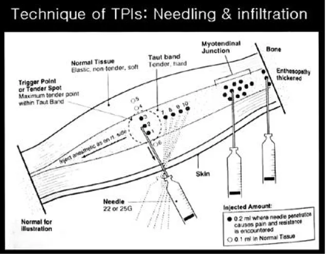 Fig. 6. Trigger point injections