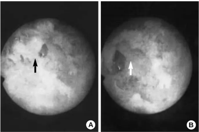 Fig. 3. Arthroscopic finding of the head of a bioabsorbable inter- inter-ference screw 33 months after operation