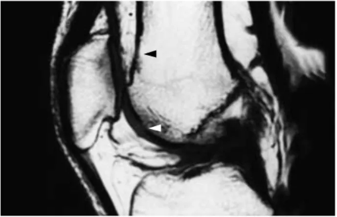 Fig. 1. Sagittal section of MR T1 WI through the knee joint of a 43 year old male patient