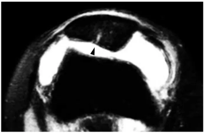 Fig. 3. Axial fat-suppressed 3D DESS MR image of the patellofe- patellofe-moral joint of a 55 year old female patient demonstrating nearly full thickness cartilage defect at the lateral facet of the patella and underlying subchondral abnormal signal, which