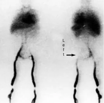 Fig. 2. Whole body Venography occluded at left common femoral vein (unidirectional solid arrow) in same patient.