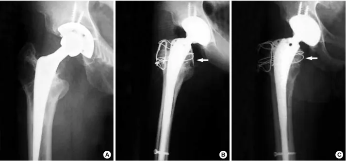 Fig. 3. (A) Preoperative anteroposterior radiograph of a 51-year-old man shows osteolysis about the acetabular component