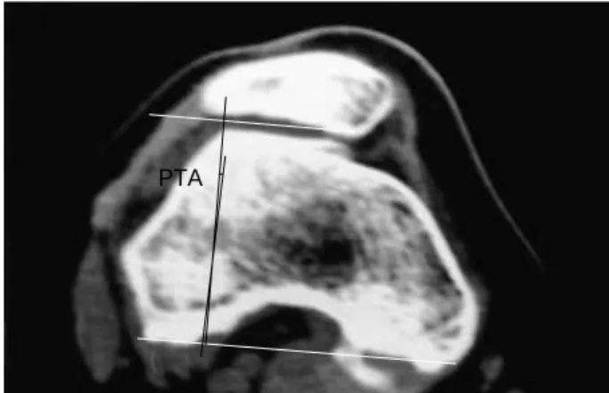 Fig. 3. Preoperative CT showing the measurement of the patella tilt angle (PTA). It also shows type III patella by Wiberg  classifica-tion and a hypoplastic femoral trochlear.