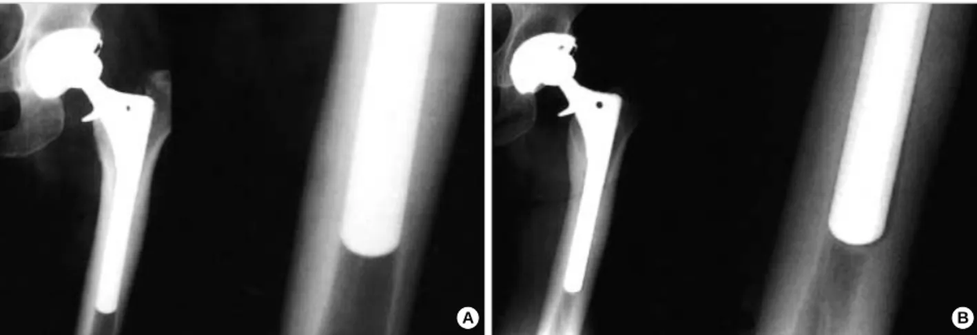 Fig. 3. A: Immediate postoperative radiographs of a 54-year-old female who presented with posttraumatic osteonecrosis shows excellent fixation