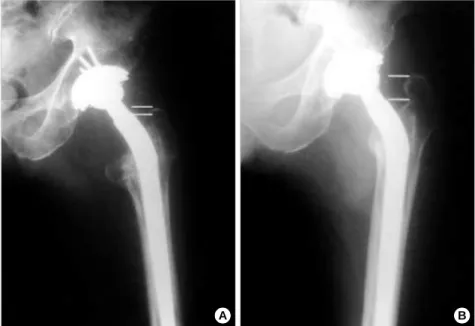 Fig. 1. A: 73 year-old man underwent revi- revi-sion total hip arthroplasty using the  Wagn-er stem