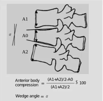 Fig. 1. Wedge angle and fomula used to measure anterior body collapse from lateral roentgenograms.