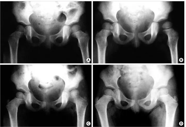 Fig. 1. 2 year old girl was taken arthrotomy two times after 1 day from symptom onset and after 14 days from 1st arthrotomy