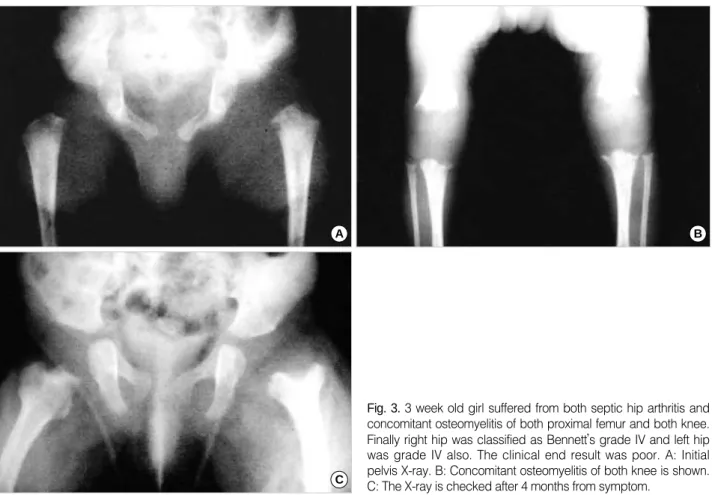 Fig. 3. 3 week old girl suffered from both septic hip arthritis and concomitant osteomyelitis of both proximal femur and both knee.