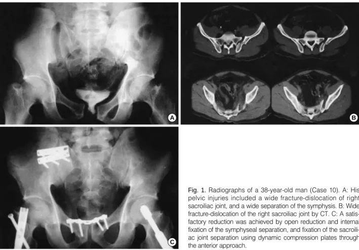 Fig. 1. Radiographs of a 38-year-old man (Case 10). A: His pelvic injuries included a wide fracture-dislocation of right sacroiliac joint, and a wide separation of the symphysis