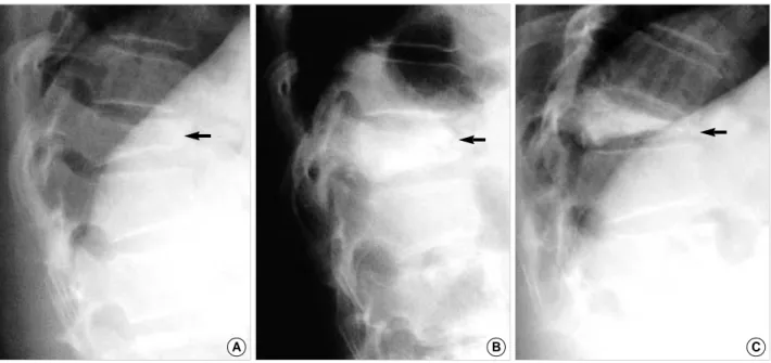 Fig. 4. Lateral radiographs of the thoracolumbar spine. A: A 66-year-old male with a compression fracture of T11