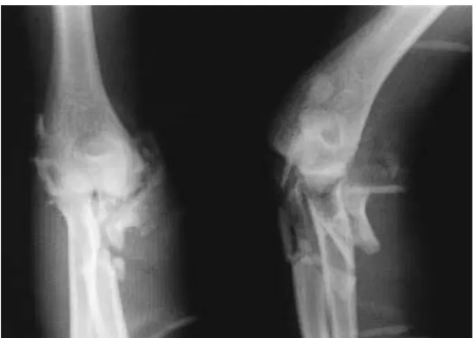 Fig. 2. Three months later, nonunion with bone defect was demon- demon-strated and ulnar neuropathy was noted clinically.