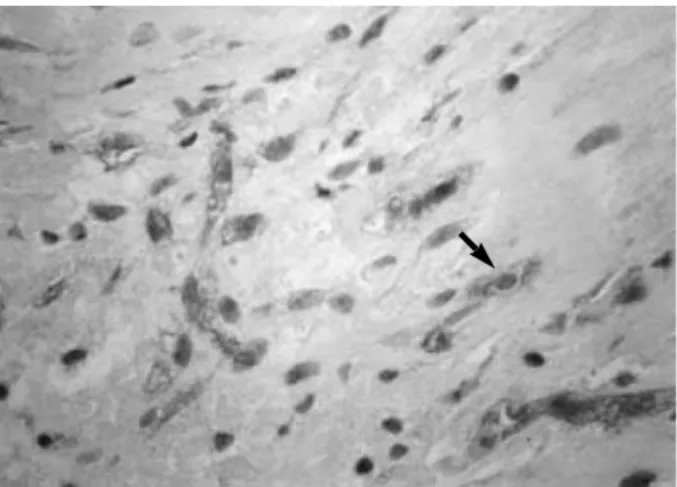 Fig. 3. H-E stain of sequestrated nucleus pulposus tissue. The sample was obtained at the margin of the sequestrated disc.