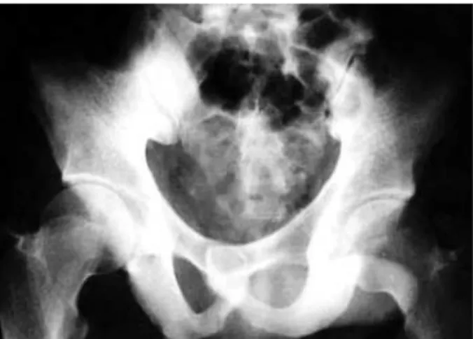 Fig. 1. The symphysis pubis was locked on this AP view of the pelvis.