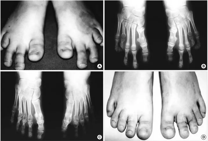 Fig. 1. A, B: Pre-operative photograph and radiograph in a 13-year-old girl with bilateral 1st and 4th brachymetatarsia