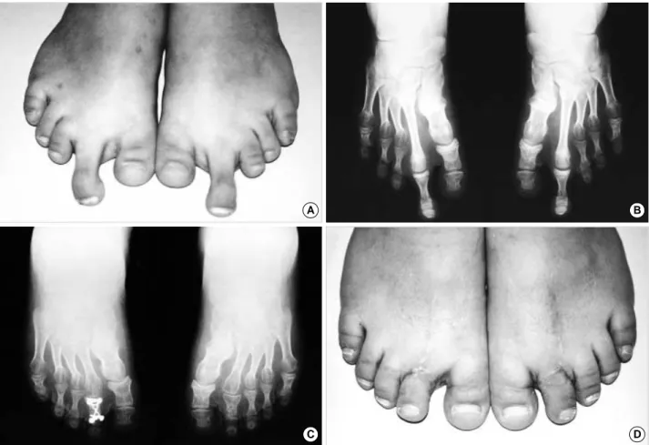Fig. 2. A, B: Pre-operative photograph and radiograph of a 12-year-old girl with bilateral 1st, 3rd, 4th, and 5th brachymetatarsia