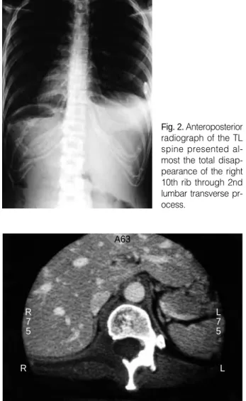 Fig. 4. Magnetic Resonance Imaging of 12th thoracic spine pre- pre-sented high signal intensity at the bone defect on T2WI.