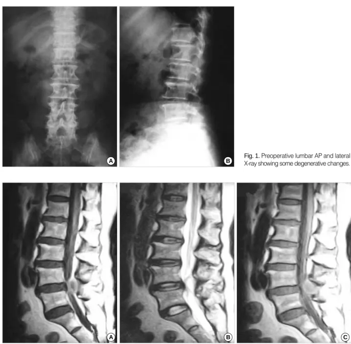 Fig. 1. Preoperative lumbar AP and lateral X-ray showing some degenerative changes.