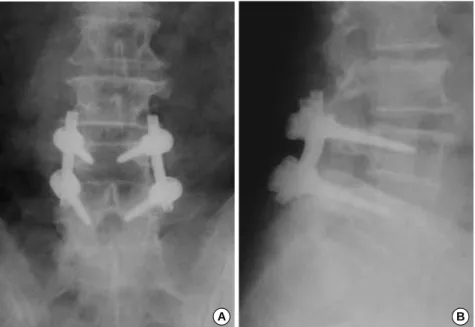 Fig. 5. POD 1 year. Pedicular screw fixa- fixa-tion and posterolateral fusion status.