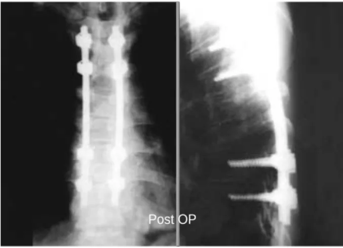 Fig. 2. After laminectomy from T5 through T8, a red vascular lesion was found on the posterior surface of the dura.