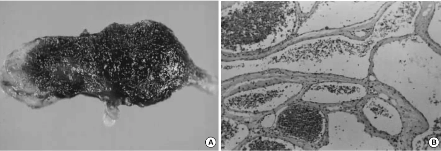Fig. 4. A: The cut surface of the tumor showing a dark-red and sponge-like appearance