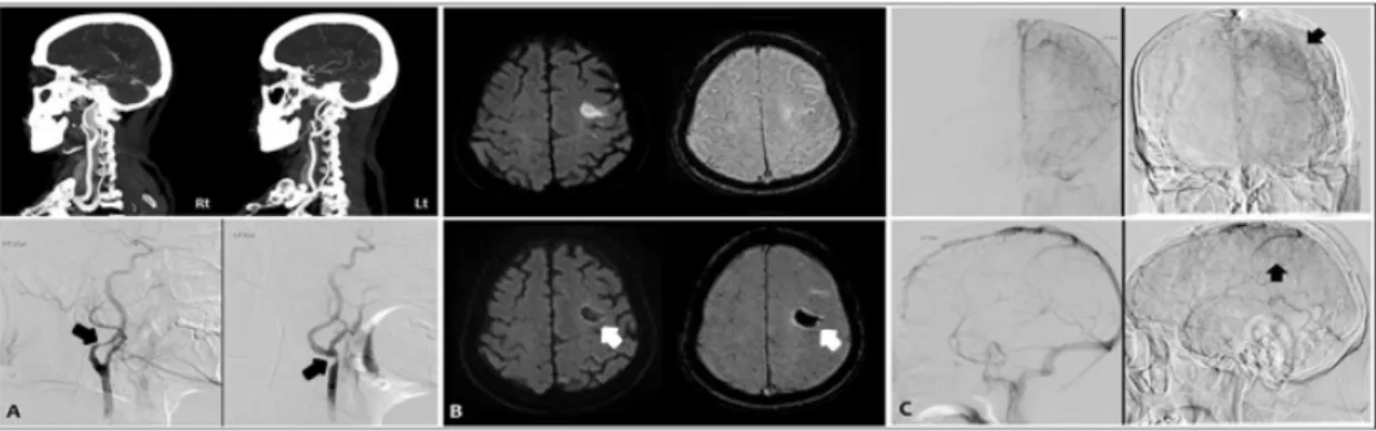 Fig. 1.  (A) Bilateral carotid artery stenosis on brain CT angiography and transfemoral cerebral angiography (asymptomatic right proximal intracranial artery stenosis: 70% (arrow), symptomatic left distal common carotid artery stenosis: 