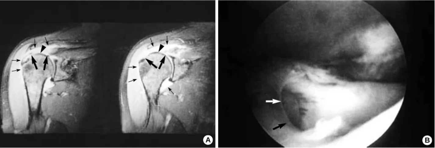 Table 1. Sensitivity, specificity and accuracy of MRI for each lesions; Comparison of MRI and arthrscopic diagnosis