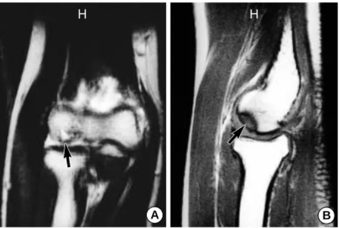 Fig. 2. Coronal image (A) of T1-weighted magnetic resonance images shows unstable detached osteochondral fragment (arrow), and sagittal image (B) shows a low signal intensity in the superficial aspect of the capitellum (arrow).