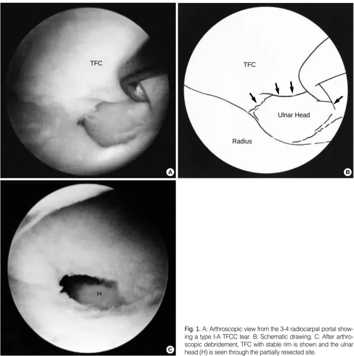 Fig. 1. A: Arthroscopic view from the 3-4 radiocarpal portal show- show-ing a type I-A TFCC tear