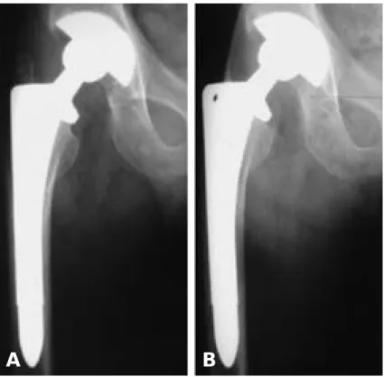Fig. 1-A. The AP radiograph shows 8 mm subsidence after 49 months follow-up.
