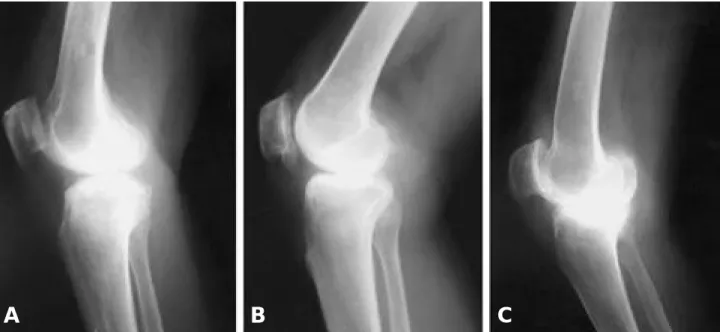 FIGURE 1. Gruop A: normal patella (10 knees)