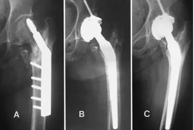 Fig. 1. A 81 year old female patient with unstable intertrochanteric fracture was fixed with compression hip screw(CHS)