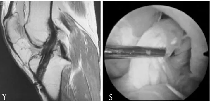 FIGURE 1. (A) The sagittal proton density image at postoperative 35 months show thick ACL graft with longitudinal streak increased signal intensity and straight orientation.