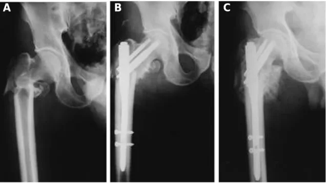 Fig. 2-A. Initial radiograph in a 34-year-old man shows unstable intertrochanteric fracture according to Evans classi- classi-fication.