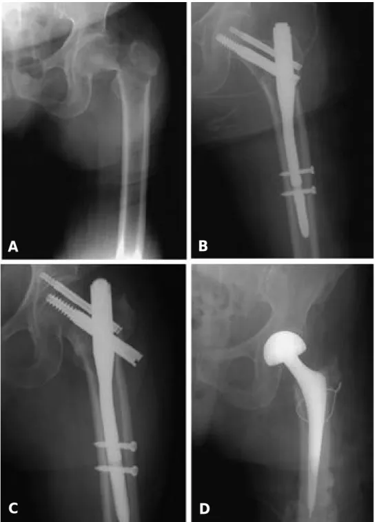 Fig. 3-A. Initial radiograph in a 72-year-old woman shows stable intertrochanteric fracture according to Evans classification.