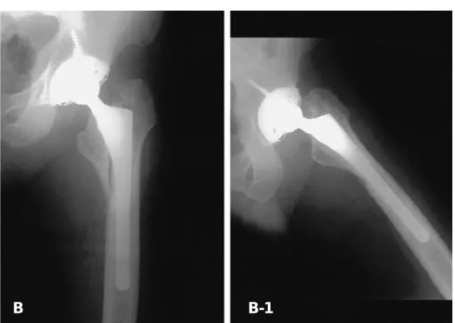 Fig. 1. B, B-1 : This preoperative AP and Lat. Radiographs showing stem subsidence(about 20mm).
