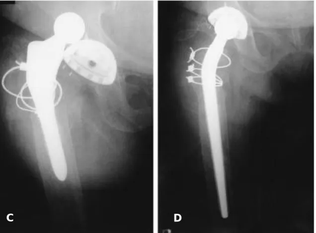 Fig. 2. D : This radiograph is revision total hip arthroplasty was performed using Wagner revision stem