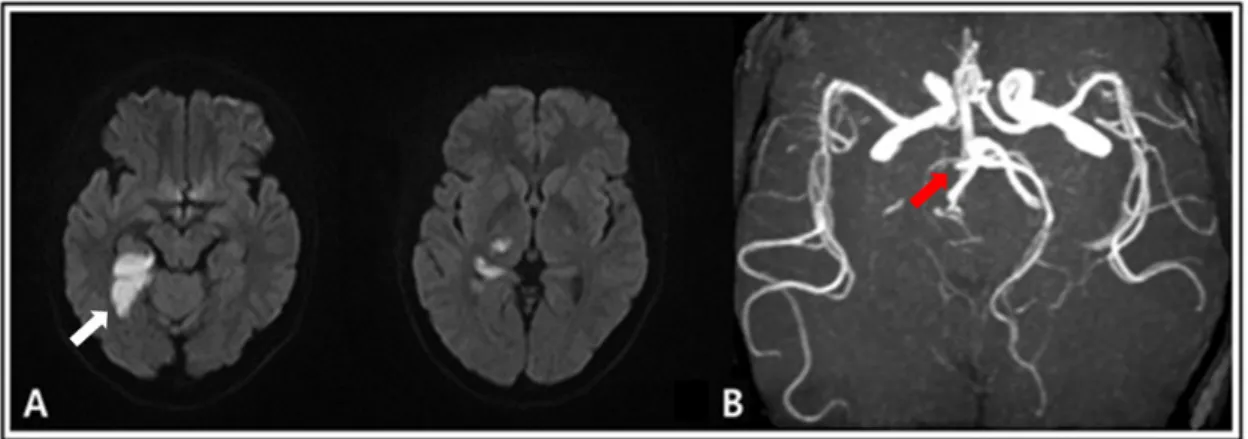 Fig. 1. Magnetic resonance image and Magnetic resonance angiography of the brain. 