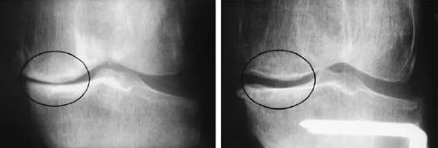 FIGURE  2. (A) Preoperative weight bearing radiograph of 62-years-old female showing narrow medial joint space about 0.3 mm.
