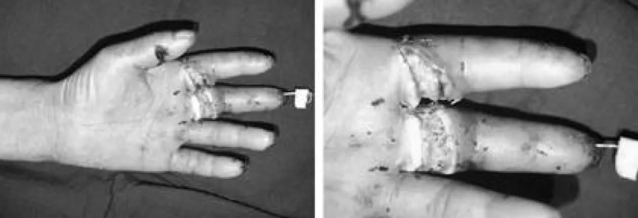 Fig. 2. After tendon graft from palmaris longus.