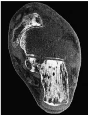 Fig. 2. Coronal computed tomographic image shows osteolytic lesion occupying the entire talus.