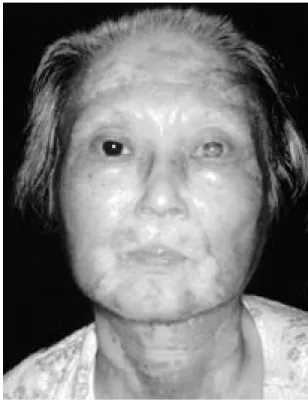 Fig. 1. Photograph of the 50 year-old patient, demon- demon-strating characteristic features of Werner  syn-drome