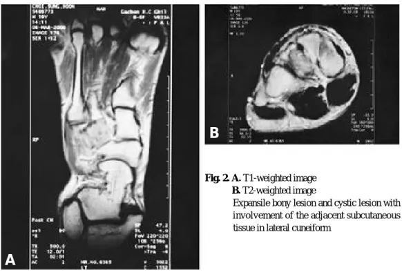 Fig. 1. The routine radiograph reveals an eccentric, oste- oste-olytic lesion involving the lateral cuneiform