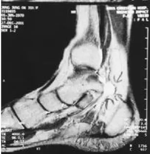 Fig. 1. Well demarcated, 1.2×0.9cm sized, soft tissue mass was on posterolateral aspect of flexor  hallu-cis longus, continued to tibial nerve.