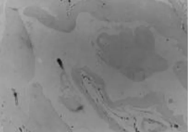 Fig. 5. The cystic wall consisting of fibroconnective tis- tis-sue without inner lining epithelium(H&amp;E stain×