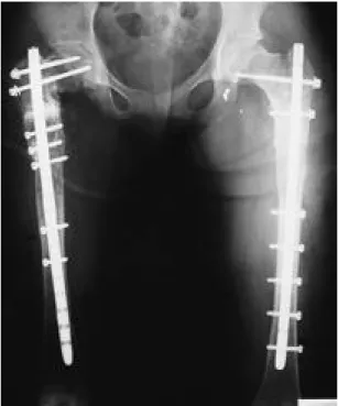 Fig. 3. An anteroposterior radiograph of the both hip shows proximal migration of right lag screw in right hip.