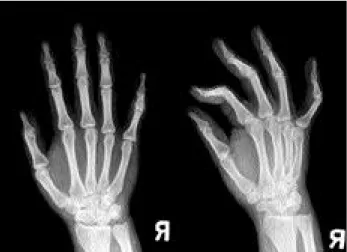 Fig. 2. MRI findings show that the tumor wrapping third flexor tendon was hyperintense in T2-weighted, and isointense compared to the surrouding skeletal muscle in T1-weighted images